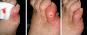 heloma plantare