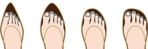 hallux_valgus Dita a griffe
